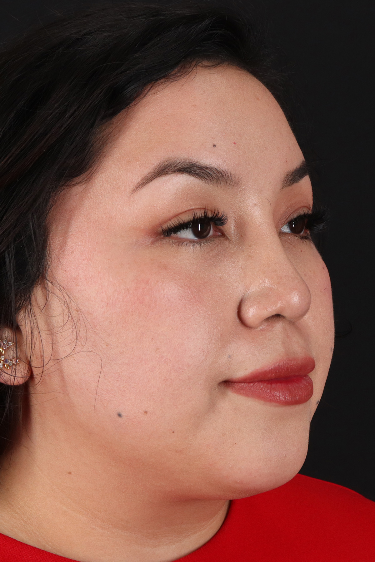 Rhinoplasty Before & After Patient #3060