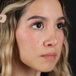 Rhinoplasty Before & After Patient #3302