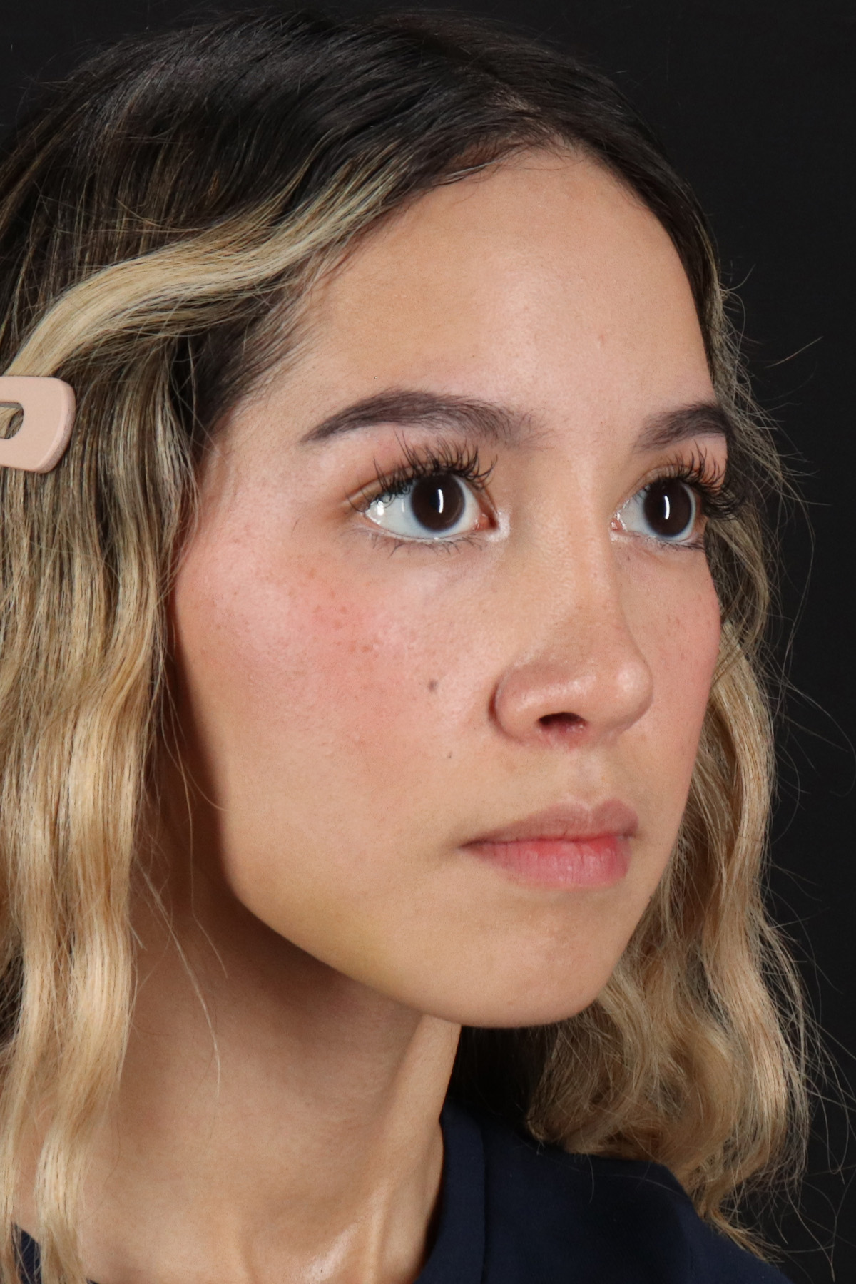 Rhinoplasty Before & After Patient #3302