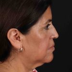 Facelift Before & After Patient #3544