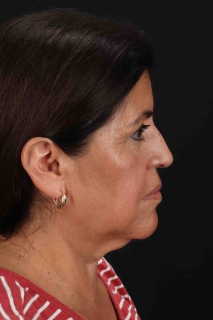 Facelift Before & After Patient #3544