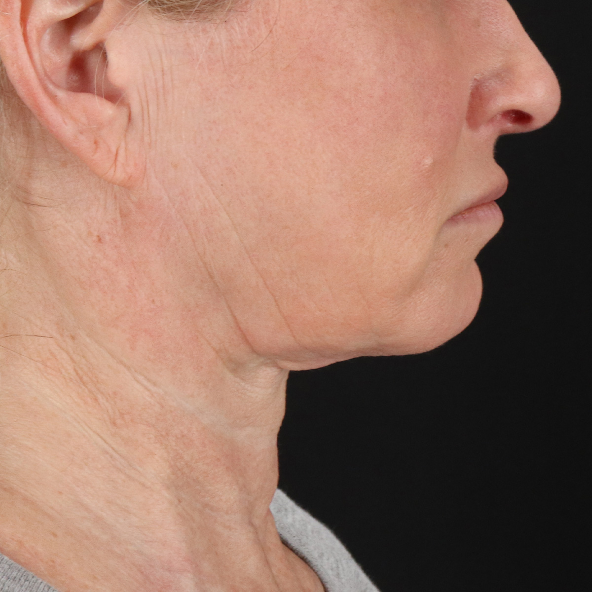 Neck Lift Before & After Patient #2571