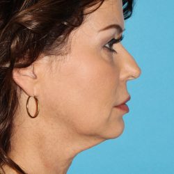 Facelift Before & After Patient #1994