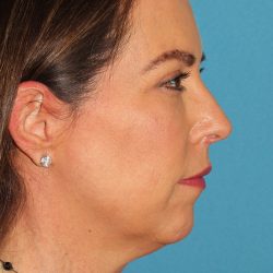 Chin Implant Before & After Patient #1659