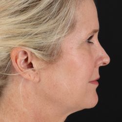 Neck Lift Before & After Patient #2582