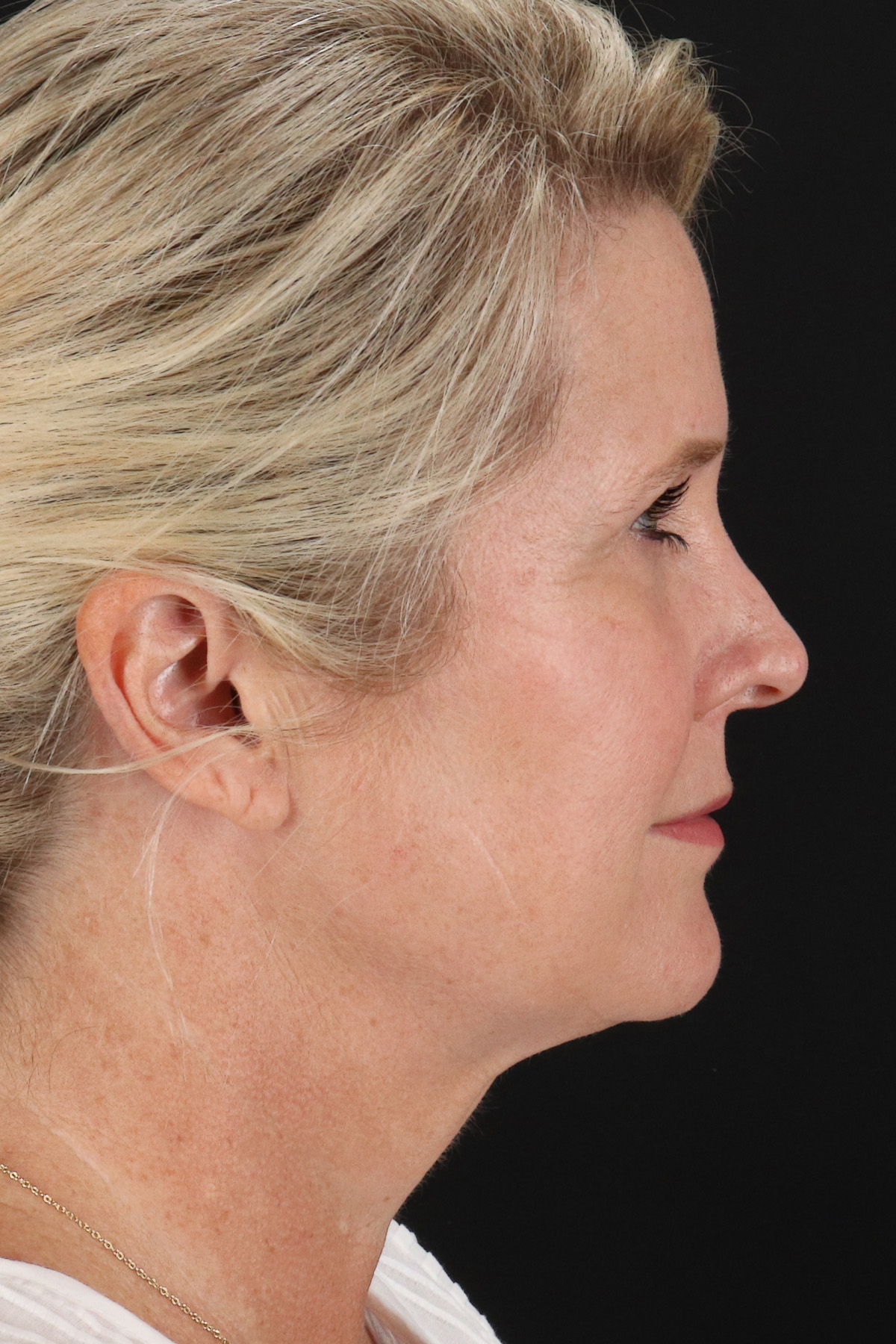 Neck Lift Before & After Patient #2582