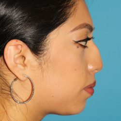 Chin Implant Before & After Patient #1670