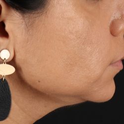 Facelift Before & After Patient #3555