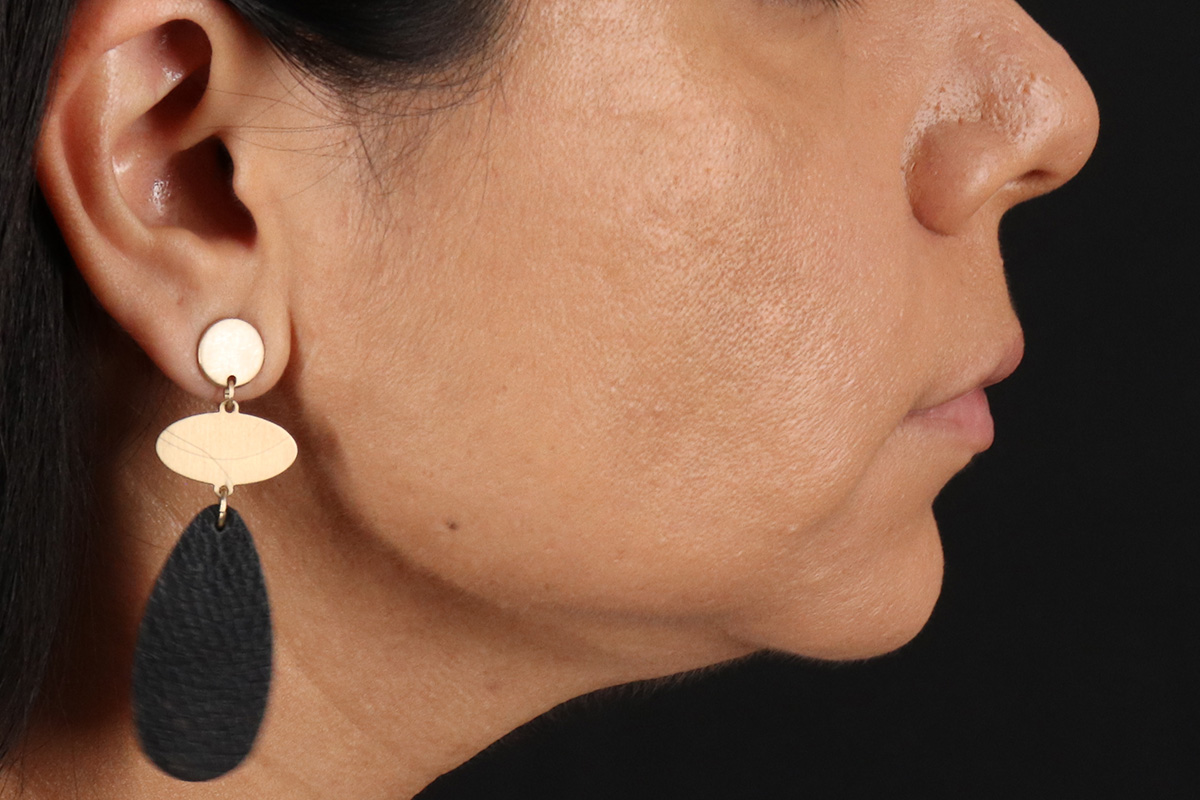 Facelift Before & After Patient #3555