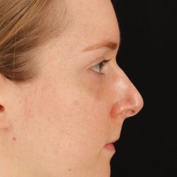 Rhinoplasty Before & After Patient #3280