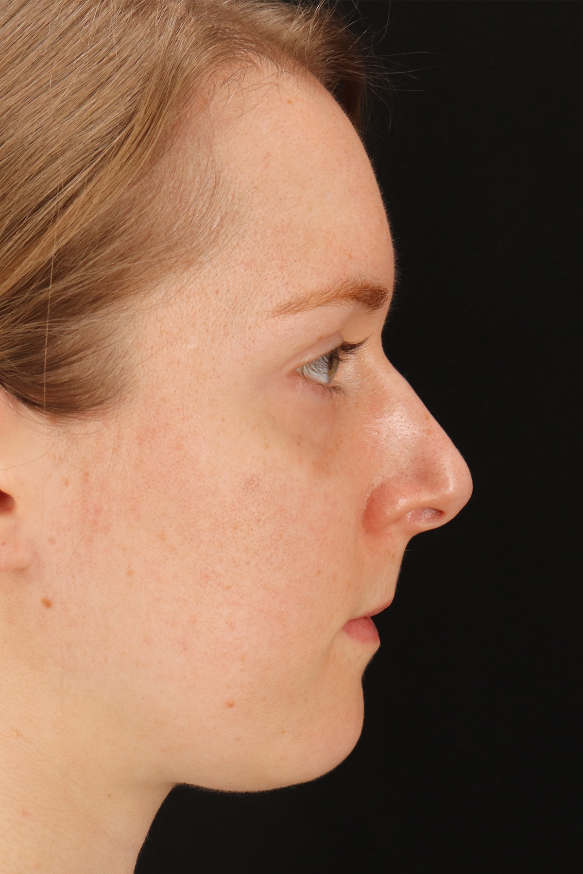 Rhinoplasty Before & After Patient #3280