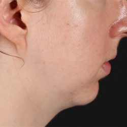 Chin Implant Before & After Patient #1562