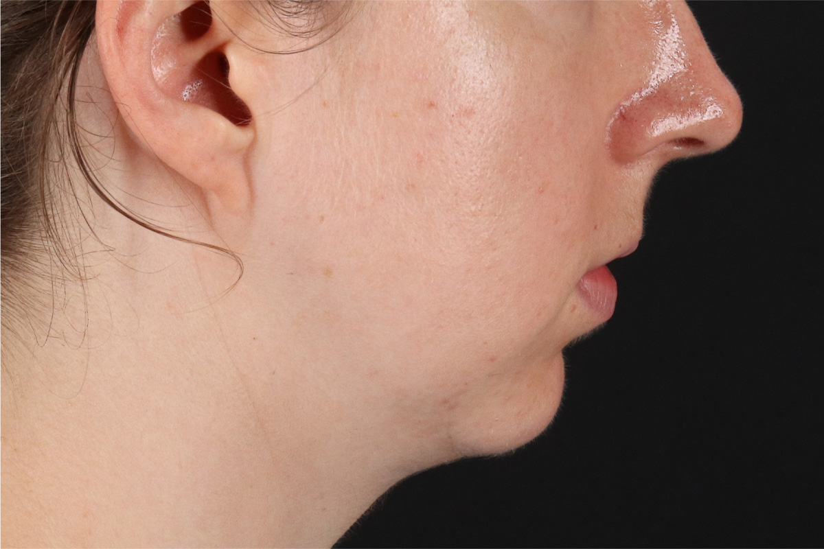 Chin Implant Before & After Patient #1562