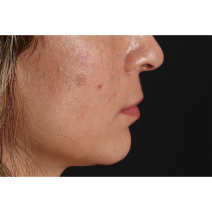 Lip Lift Before & After Patient #2166
