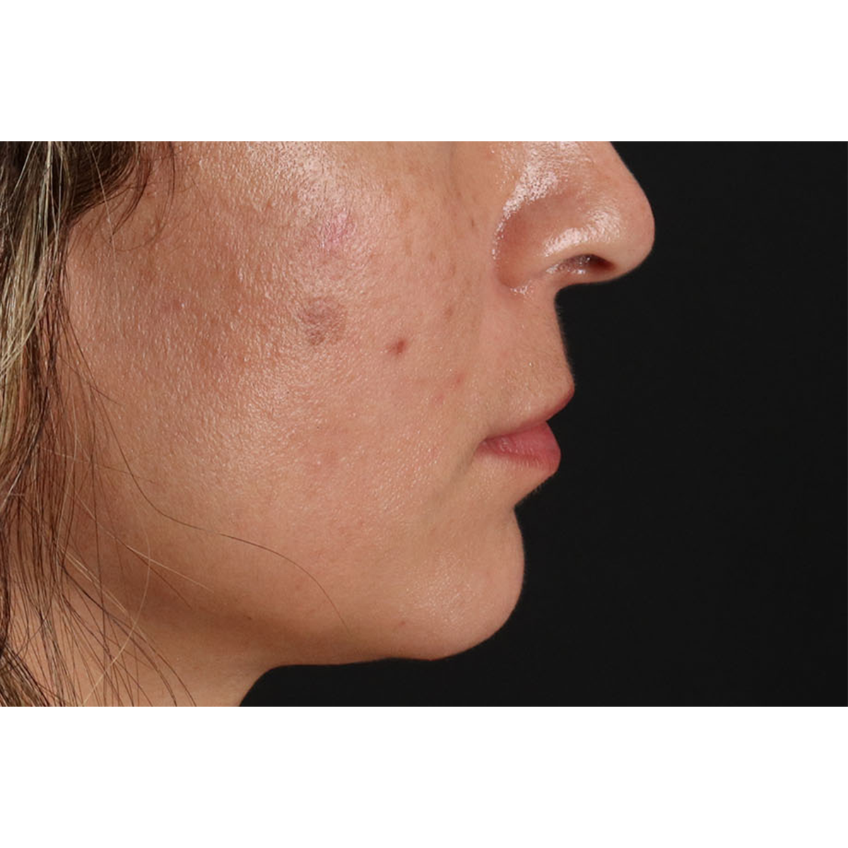 Lip Lift Before & After Patient #2166