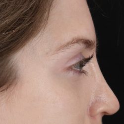 Browlift Before & After Patient #1319
