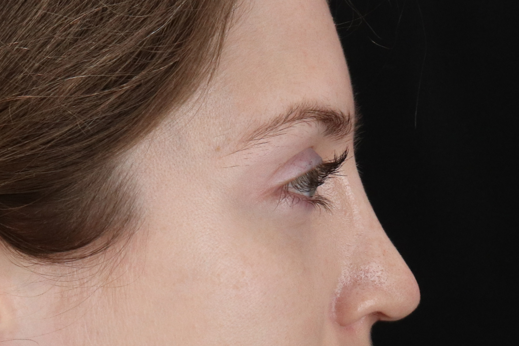 Browlift Before & After Patient #1319