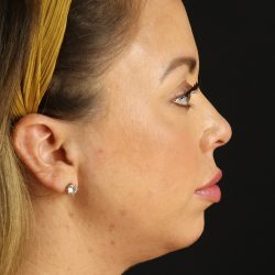 Neck Lift Before & After Patient #2505