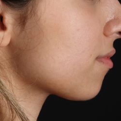 Chin Implant Before & After Patient #1573