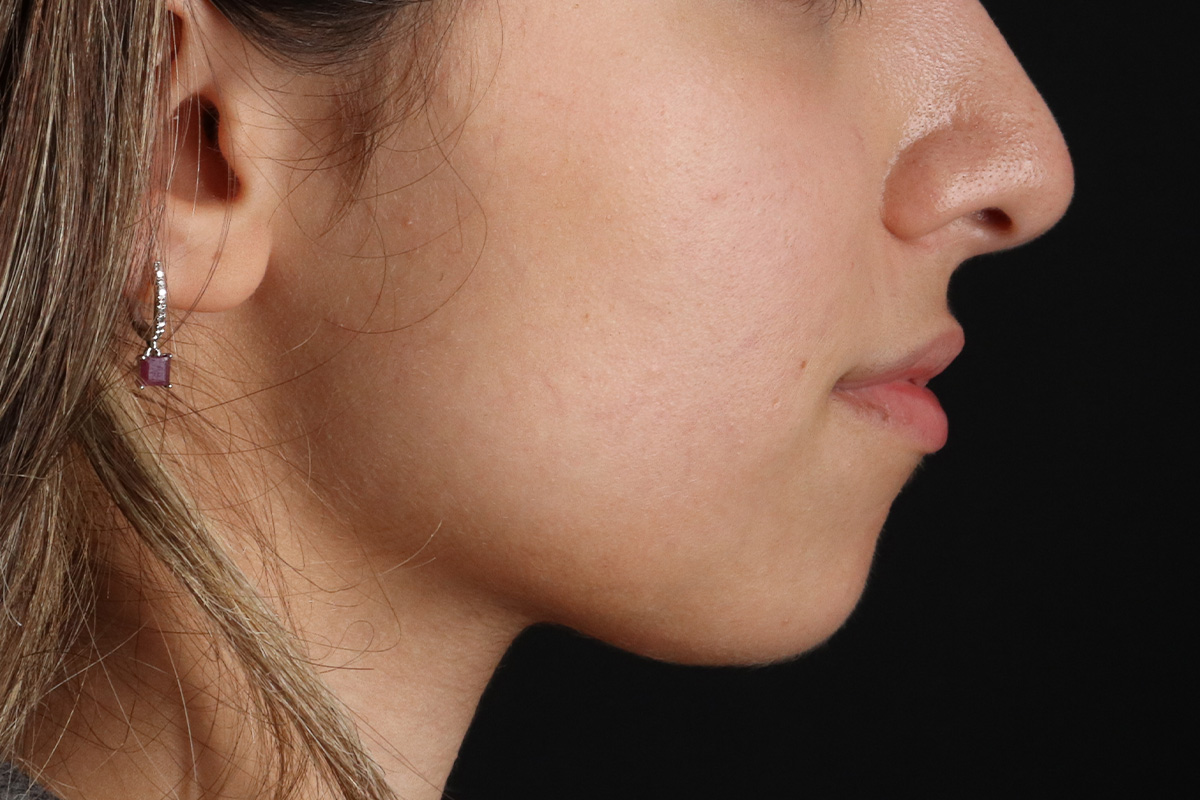 Chin Implant Before & After Patient #1573
