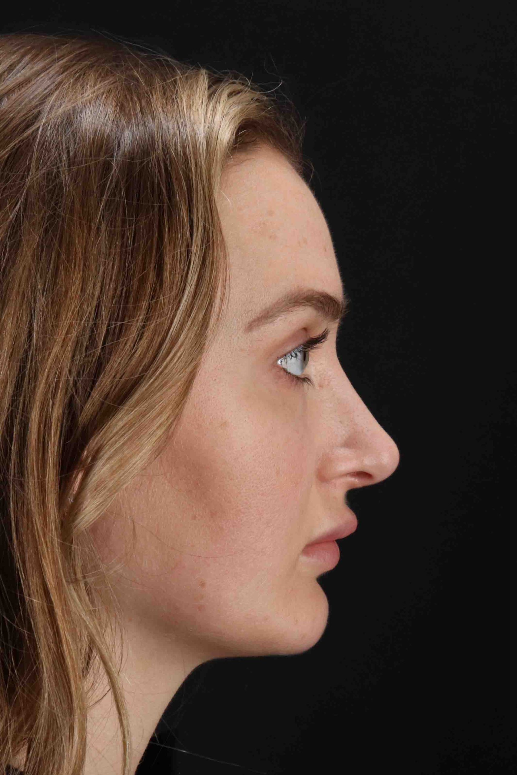 Browlift Before & After Patient #1297