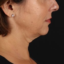 Neck Lift Before & After Patient #2472