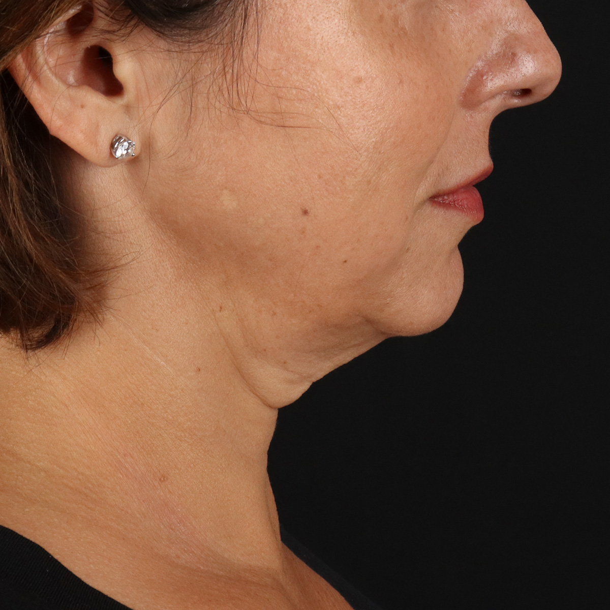 Neck Lift Before & After Patient #2472