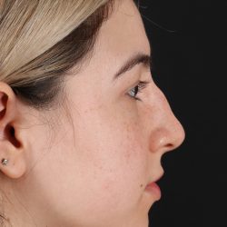 Rhinoplasty Before & After Patient #3247