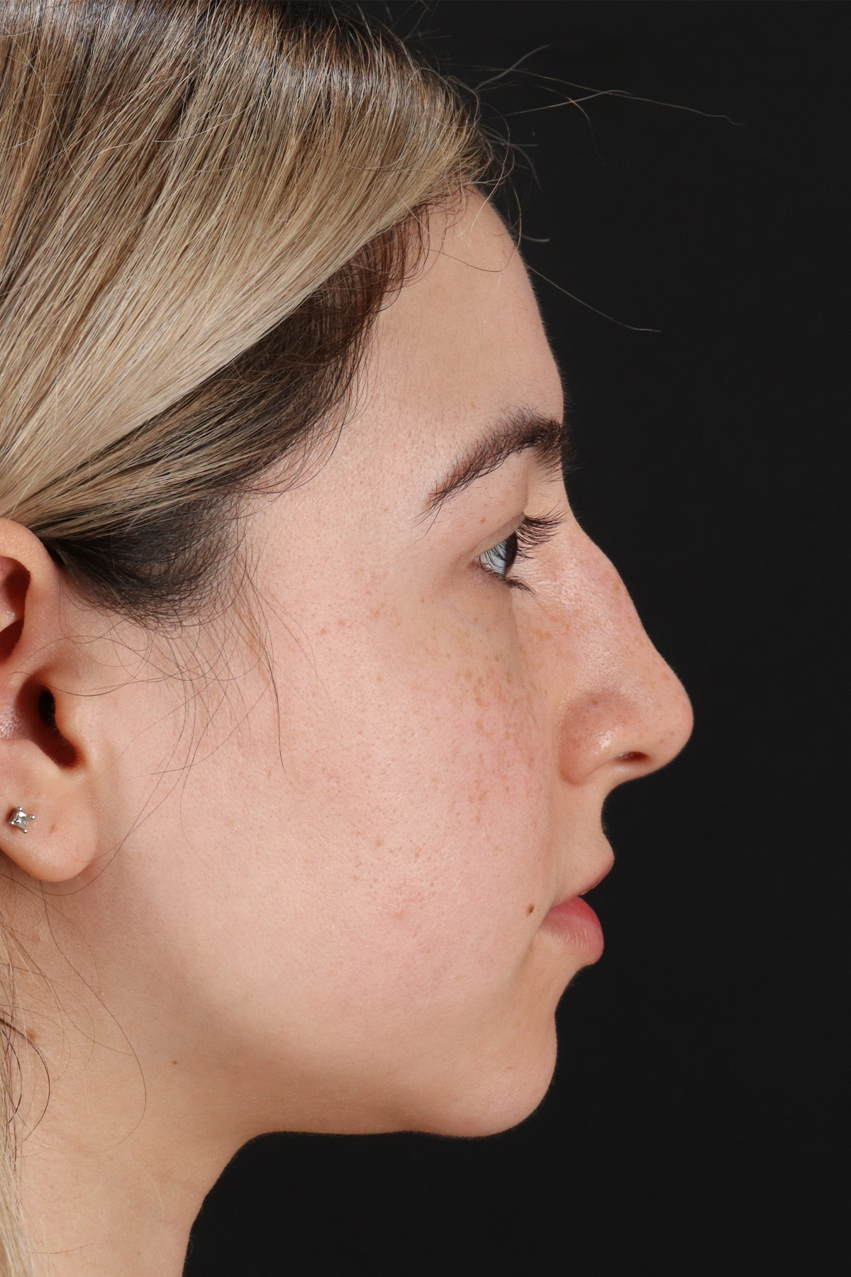 Rhinoplasty Before & After Patient #3247
