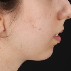 Chin Implant Before & After Patient #1551