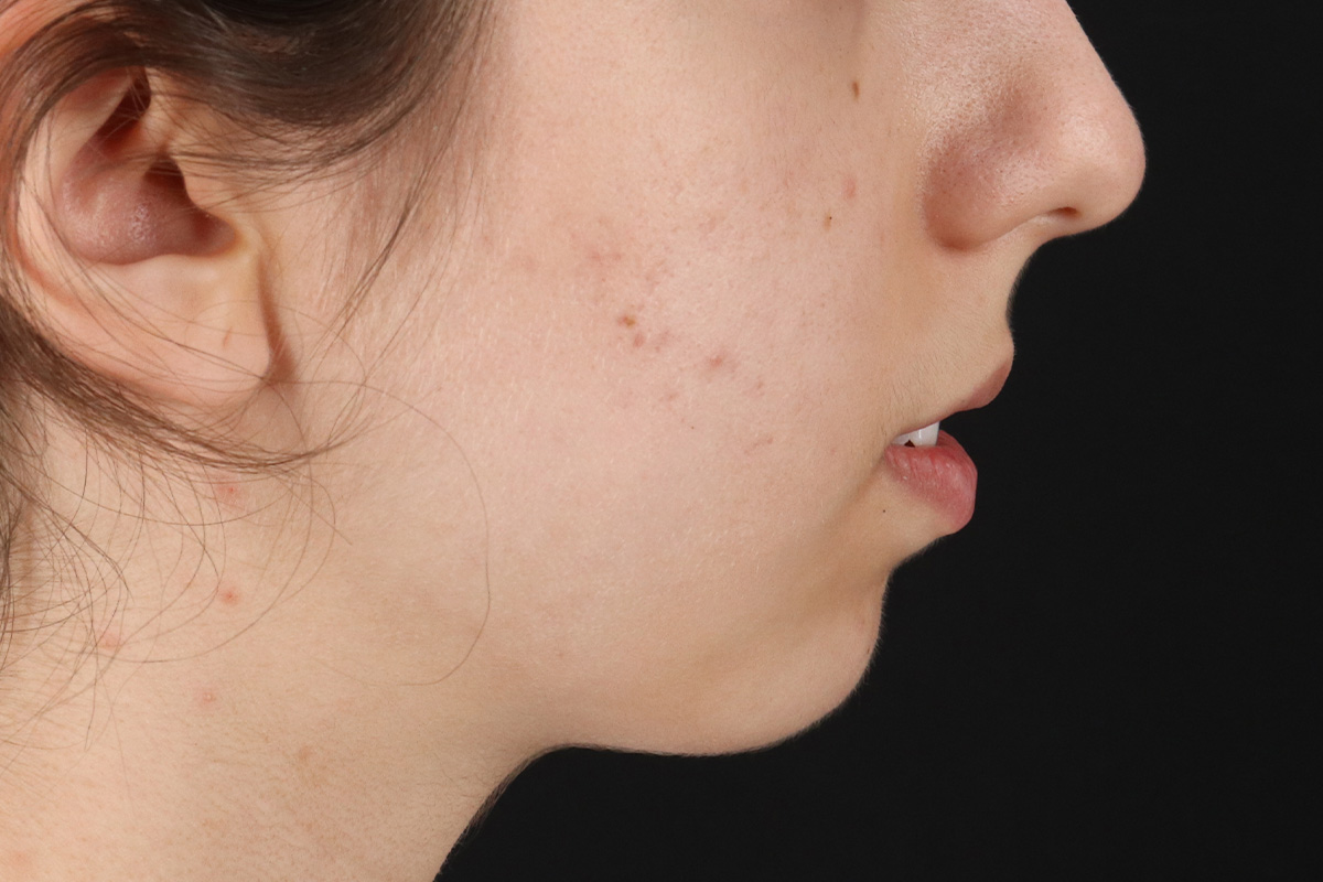 Chin Implant Before & After Patient #1551
