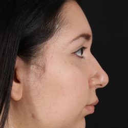Chin Implant Before & After Patient #1604