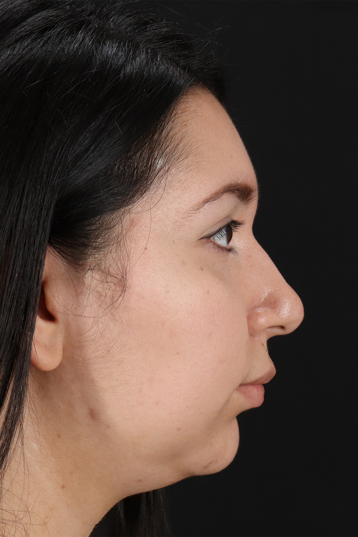 Chin Implant Before & After Patient #1604