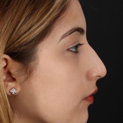 Liquid Rhinoplasty Before & After Patient #2254
