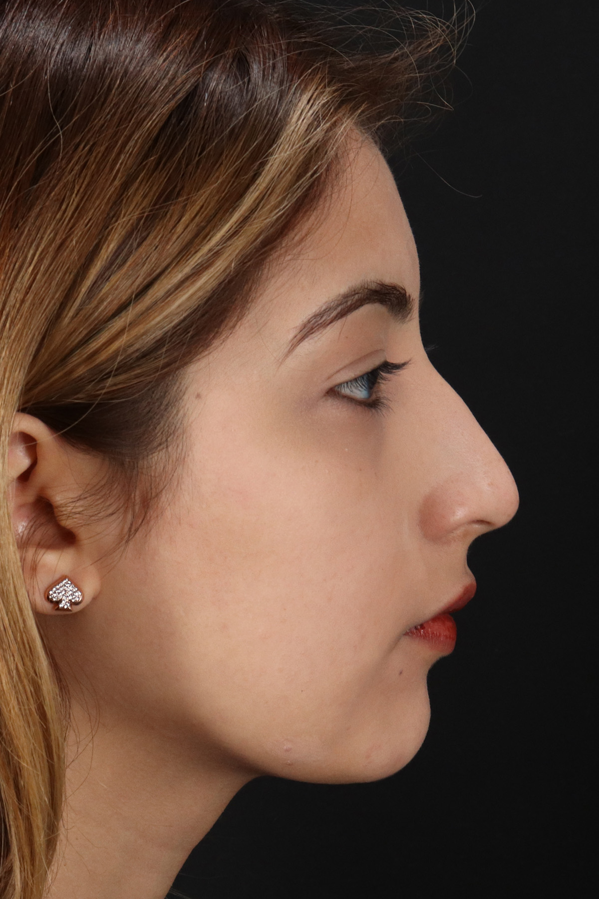 Liquid Rhinoplasty Before & After Patient #2254