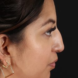 Rhinoplasty Before & After Patient #3049