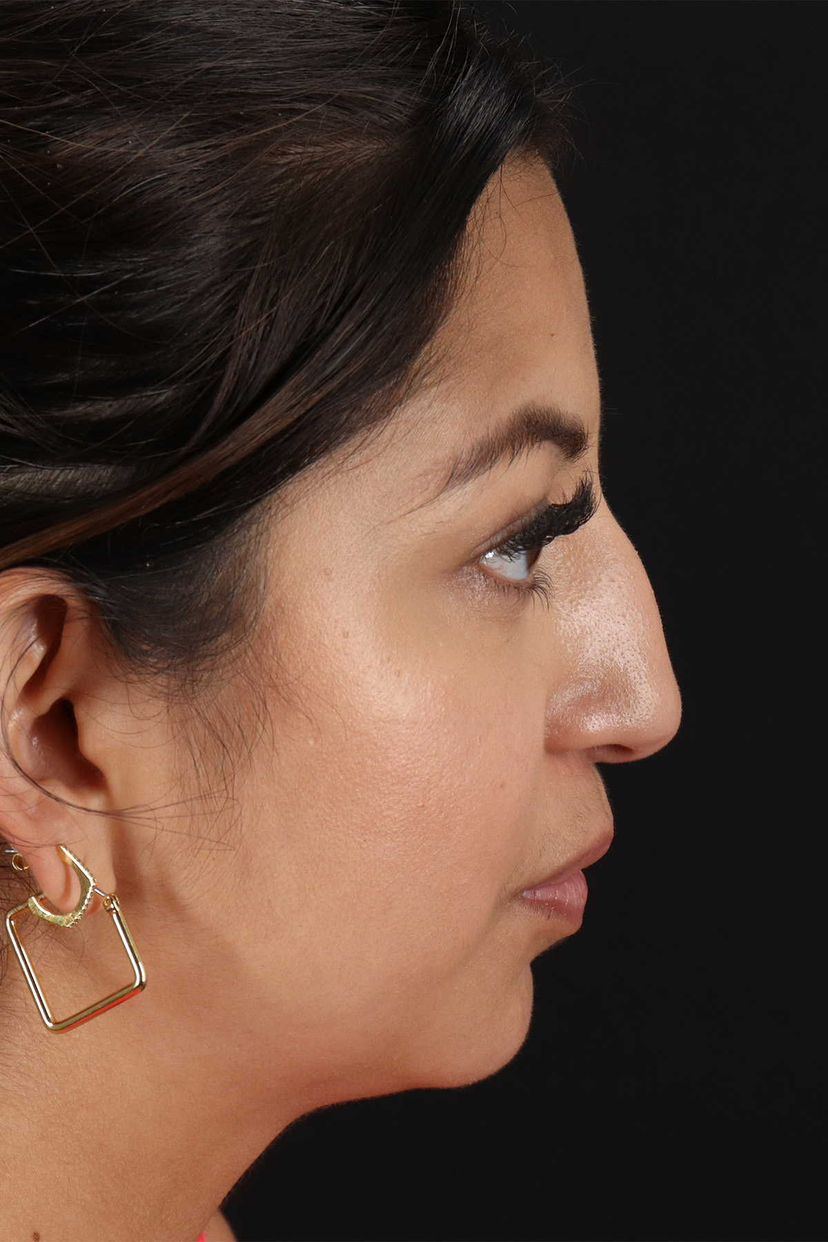 Rhinoplasty Before & After Patient #3049