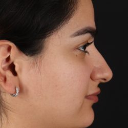 Rhinoplasty Before & After Patient #3071
