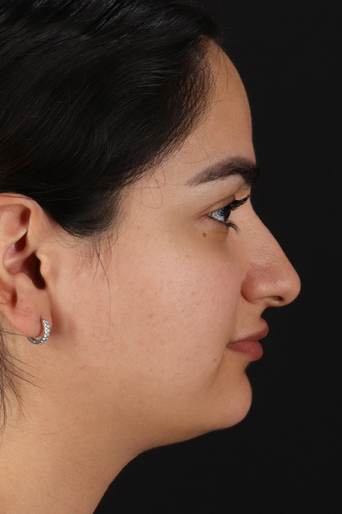 Rhinoplasty Before & After Patient #3071