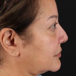 Neck Lift Before & After Patient #2593
