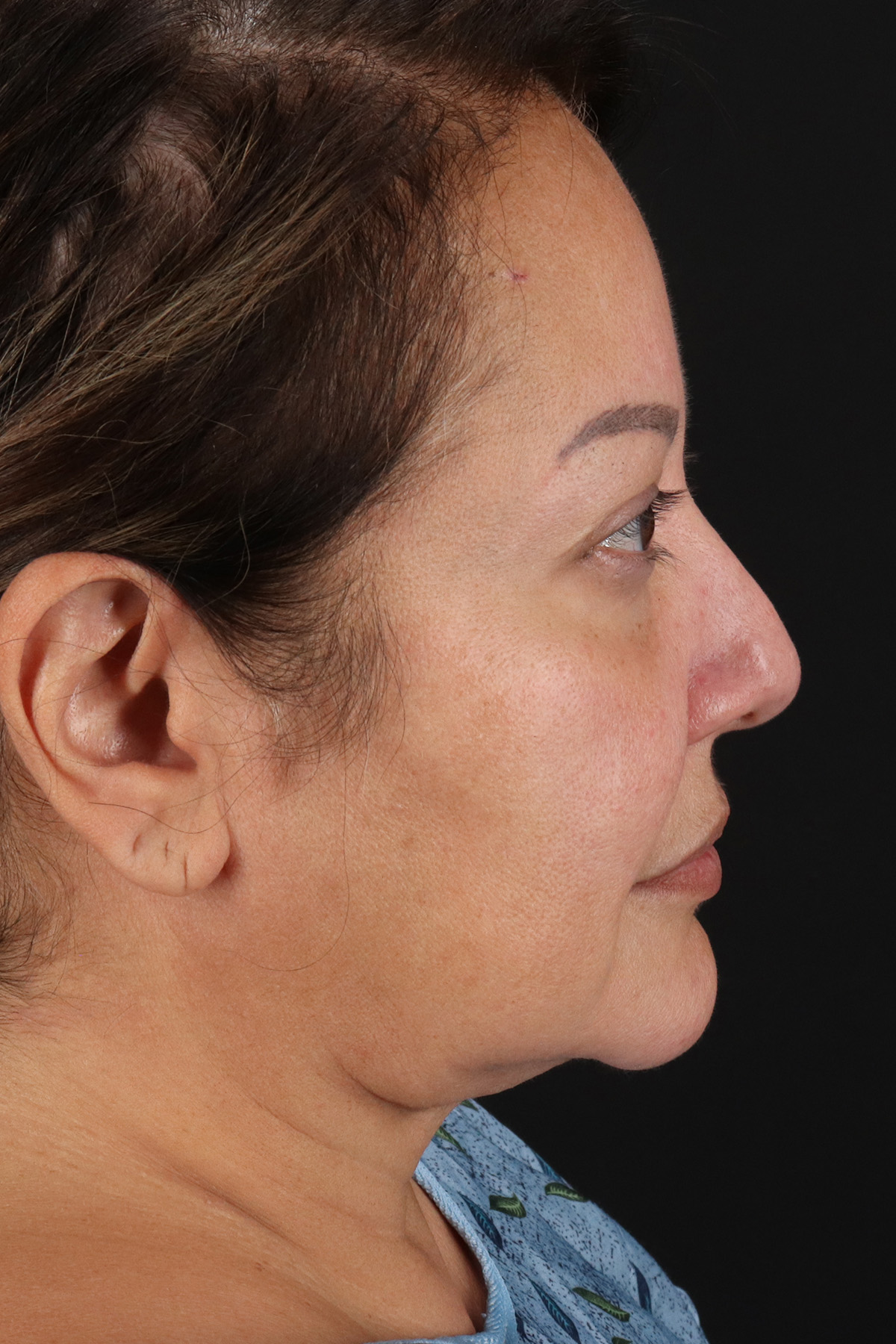 Facelift Before & After Patient #1888