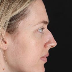 Rhinoplasty Before & After Patient #3291