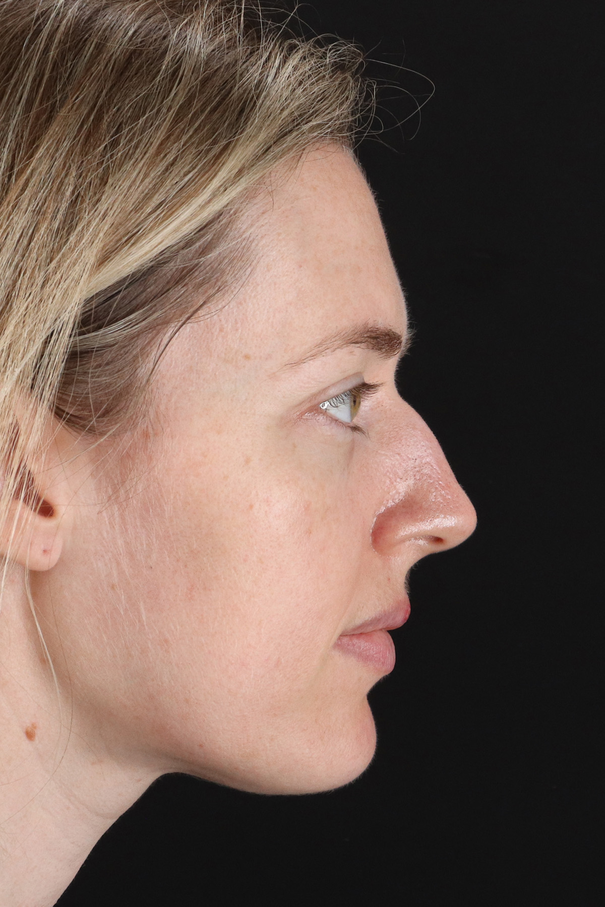Rhinoplasty Before & After Patient #3291