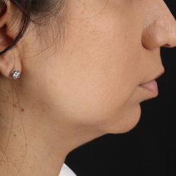 Chin Implant Before & After Patient #1540