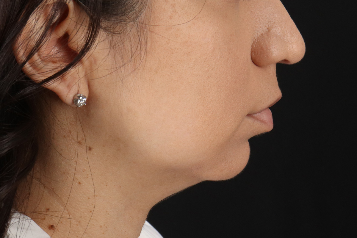 Chin Implant Before & After Patient #1540