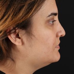 Neck Lift Before & After Patient #2560