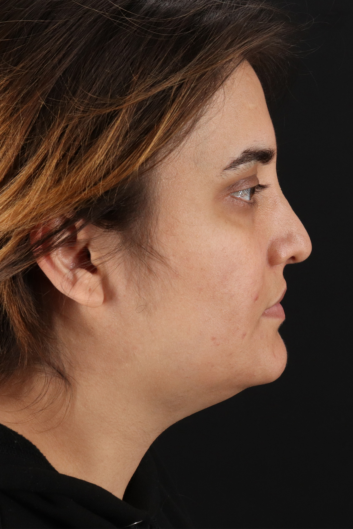 Neck Lift Before & After Patient #2560