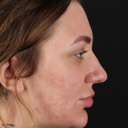 Rhinoplasty Before & After Patient #3104