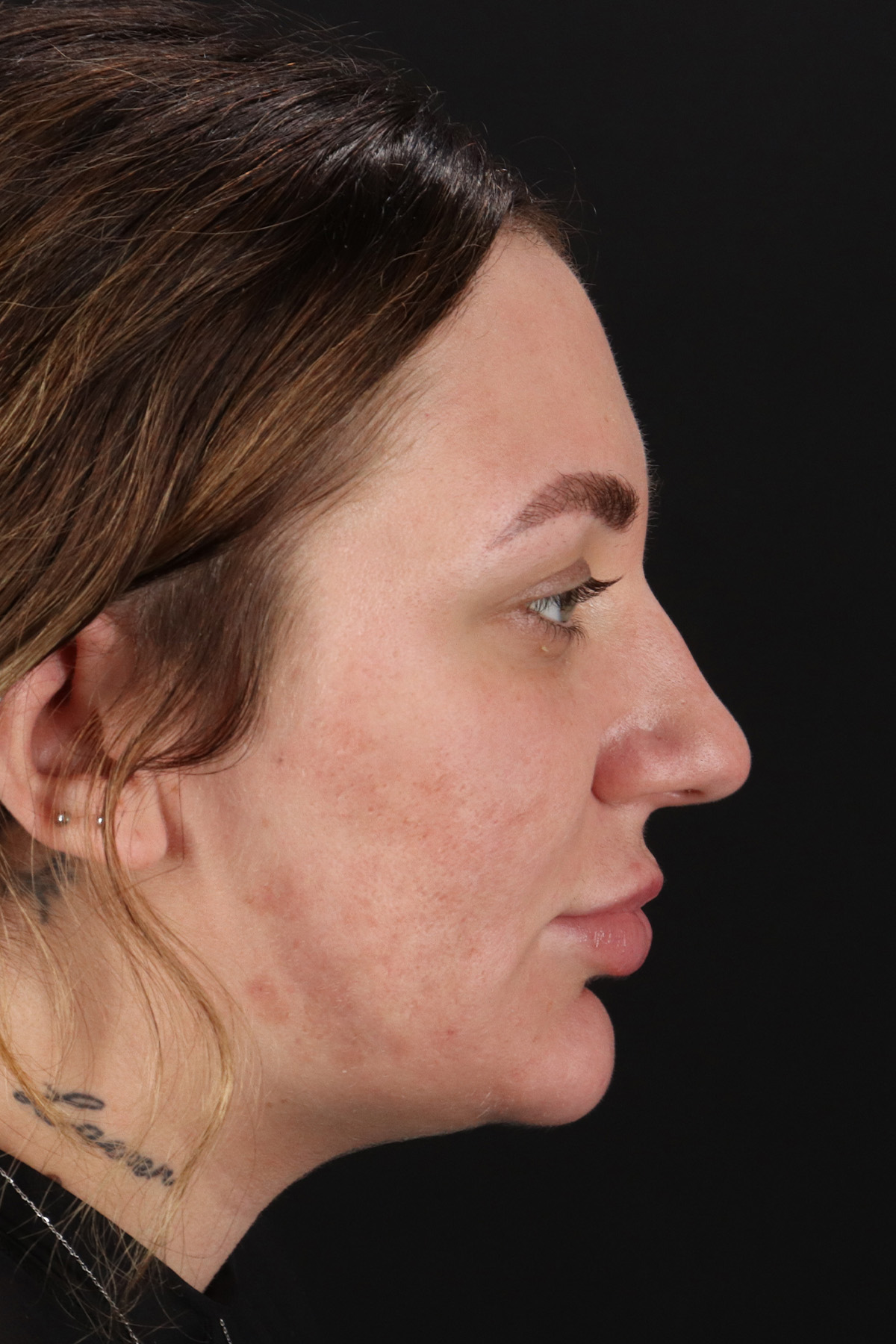 Rhinoplasty Before & After Patient #3104