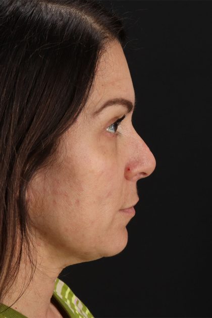 Lip Lift Before & After Patient #2133
